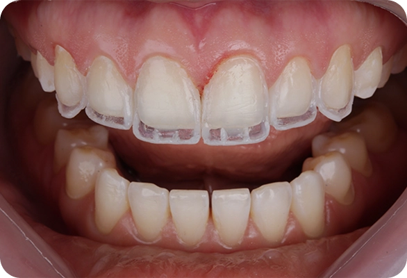 Carillas dentales tratamiento